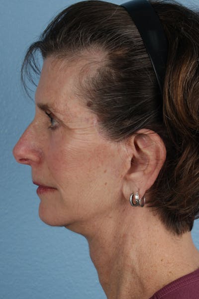Hidden Patients Before & After Gallery - Patient 414780 - Image 2