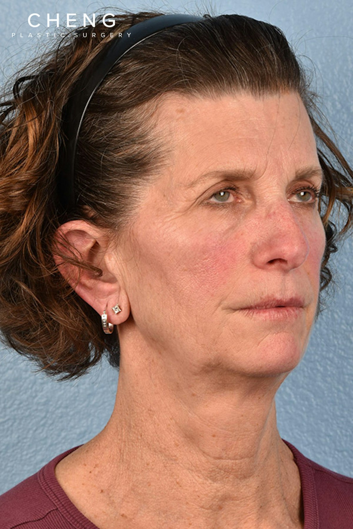 Hidden Patients Before & After Gallery - Patient 414780 - Image 3