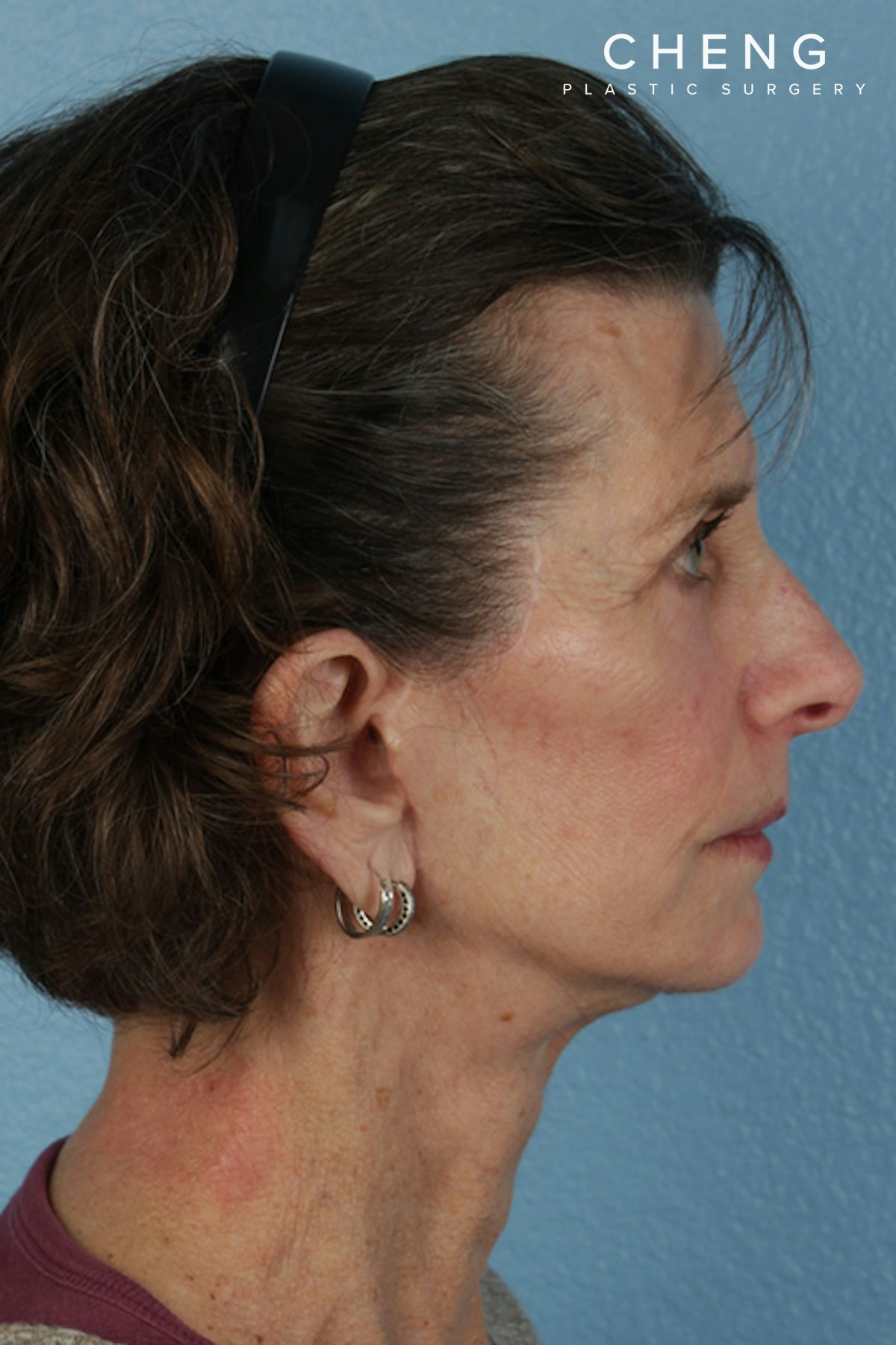 Hidden Patients Before & After Gallery - Patient 414780 - Image 6