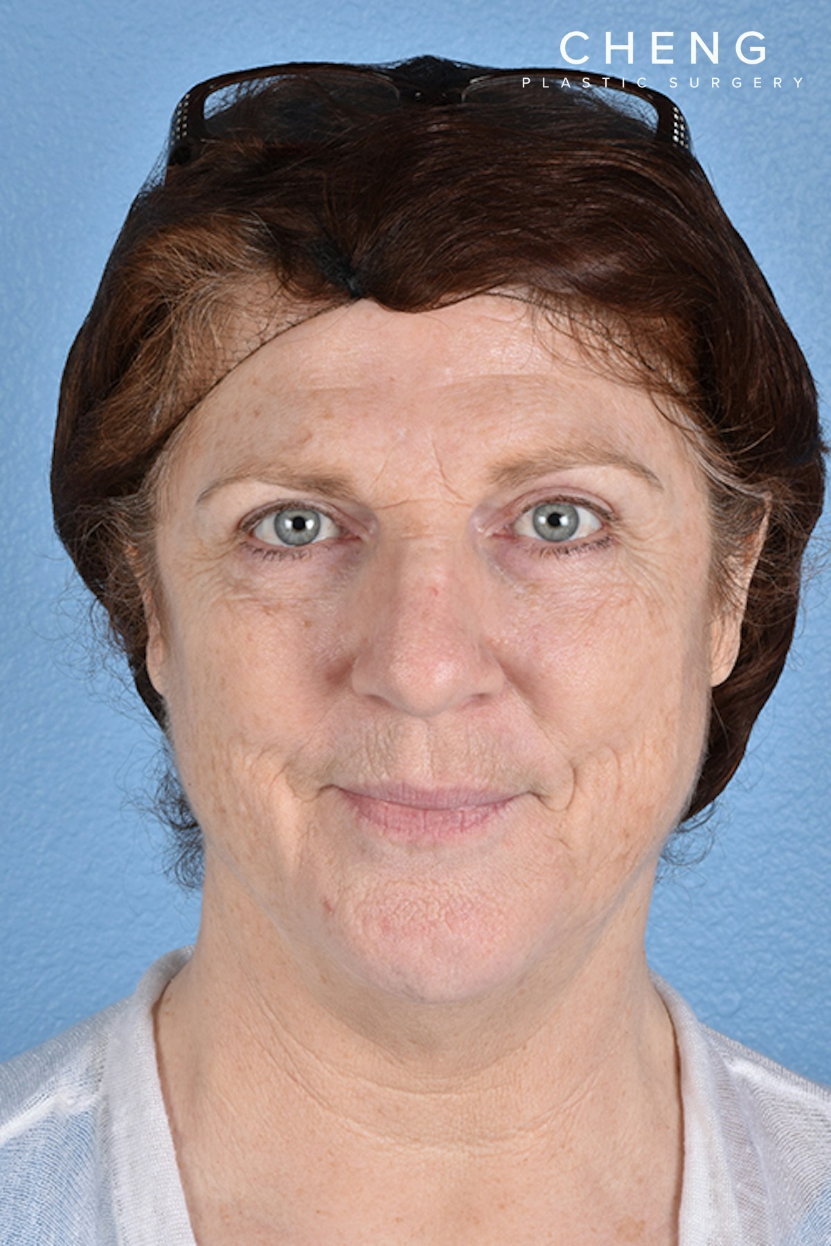Hidden Patients Before & After Gallery - Patient 100587 - Image 2