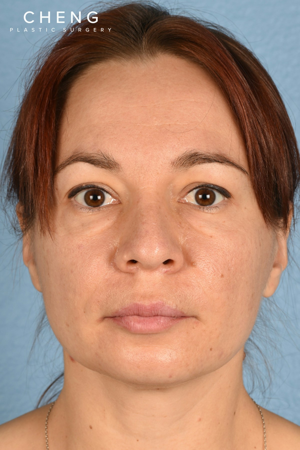 Hidden Patients Before & After Gallery - Patient 363424 - Image 1