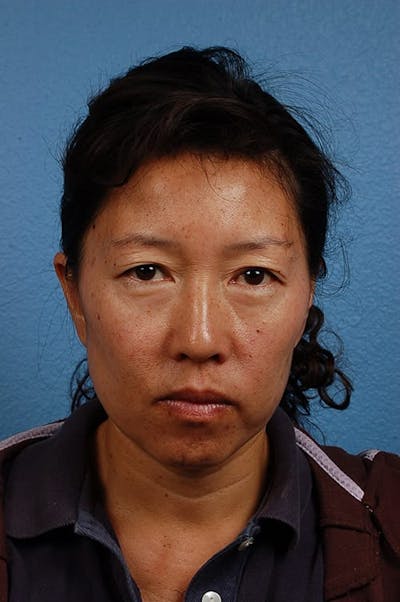 Hidden Patients Before & After Gallery - Patient 767922 - Image 1
