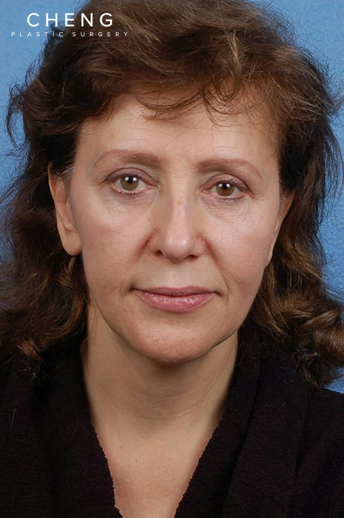 Hidden Patients Before & After Gallery - Patient 133964 - Image 1