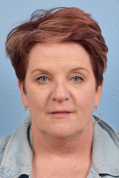 Hidden Patients Before & After Gallery - Patient 167428 - Image 1