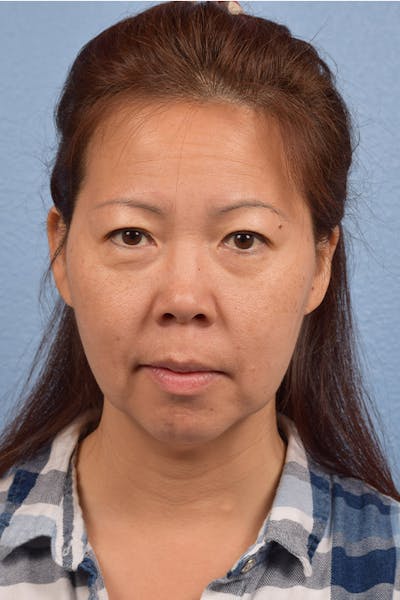 Hidden Patients Before & After Gallery - Patient 272098 - Image 1