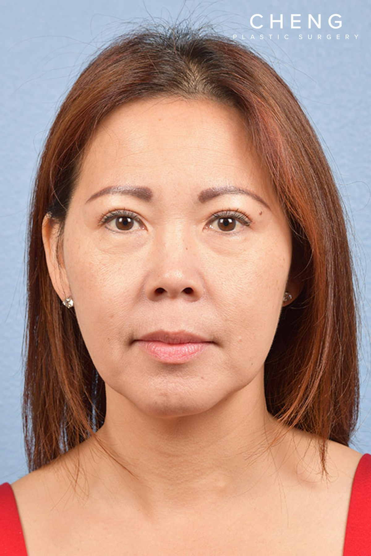 Hidden Patients Before & After Gallery - Patient 272098 - Image 2