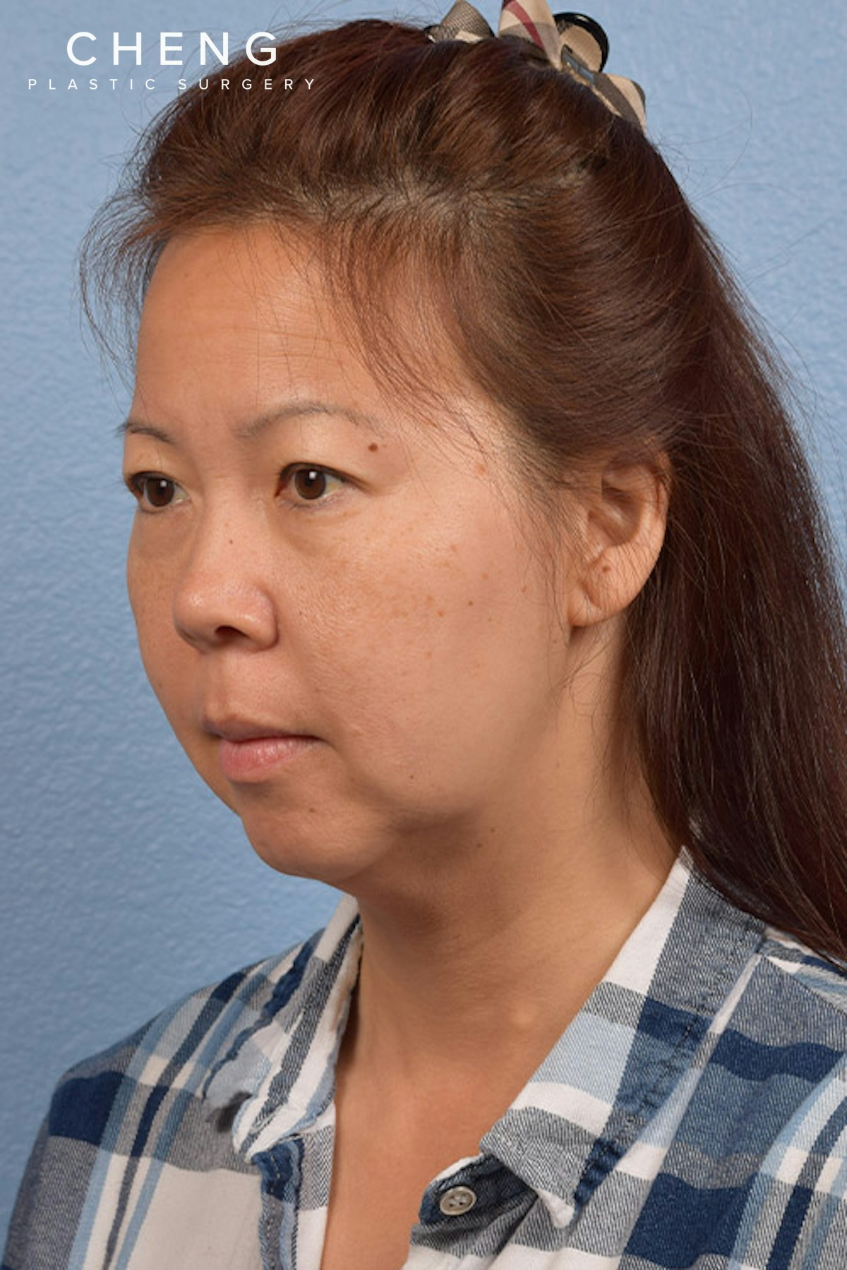 Hidden Patients Before & After Gallery - Patient 272098 - Image 3