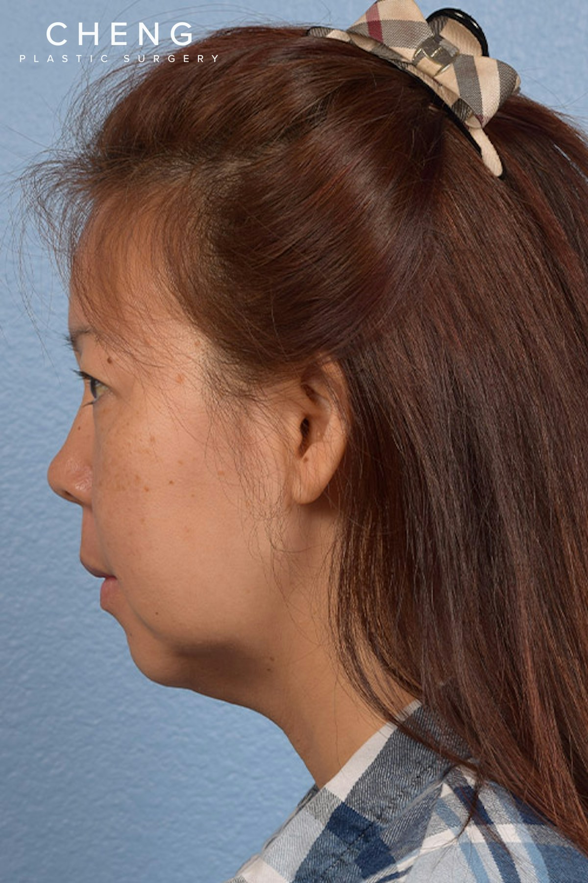Hidden Patients Before & After Gallery - Patient 272098 - Image 5