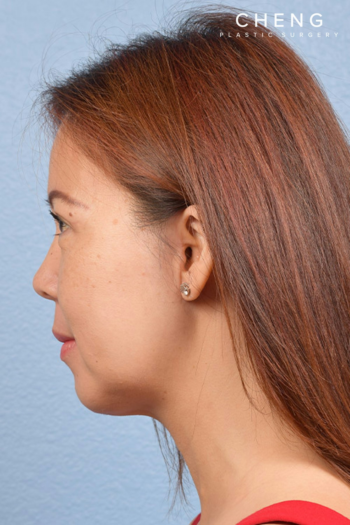 Hidden Patients Before & After Gallery - Patient 272098 - Image 6
