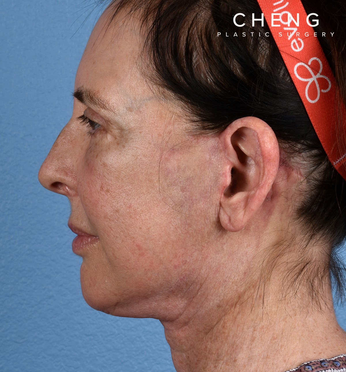 Hidden Patients Before & After Gallery - Patient 345137 - Image 10