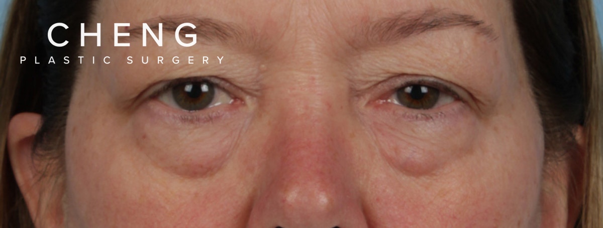 Hidden Patients Before & After Gallery - Patient 220069 - Image 1