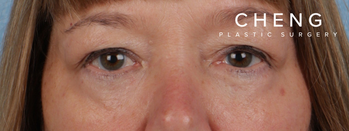 Hidden Patients Before & After Gallery - Patient 220069 - Image 2