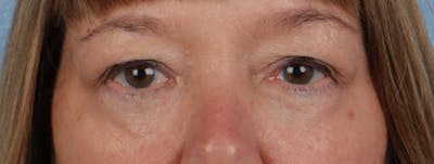 Hidden Patients Before & After Gallery - Patient 220069 - Image 2