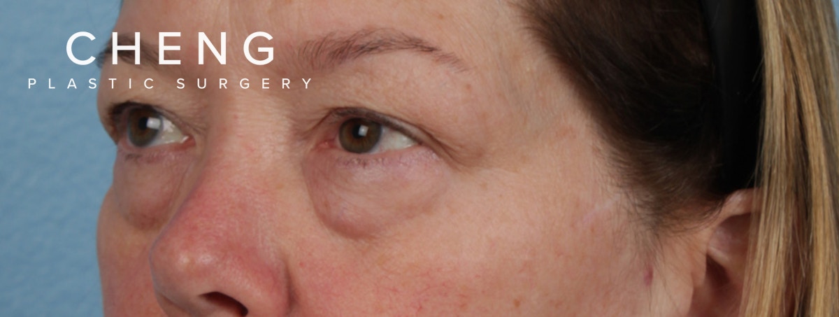 Hidden Patients Before & After Gallery - Patient 220069 - Image 3