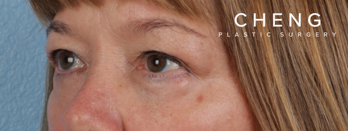 Hidden Patients Before & After Gallery - Patient 220069 - Image 4