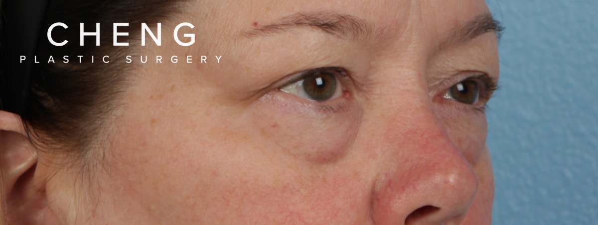 Hidden Patients Before & After Gallery - Patient 220069 - Image 5
