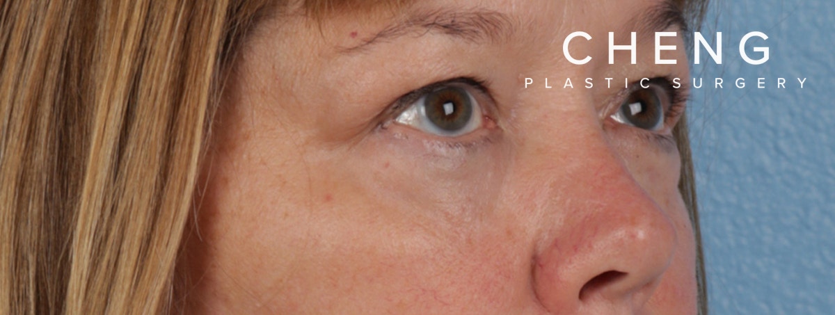 Hidden Patients Before & After Gallery - Patient 220069 - Image 6