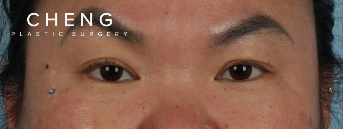 Hidden Patients Before & After Gallery - Patient 873403 - Image 1