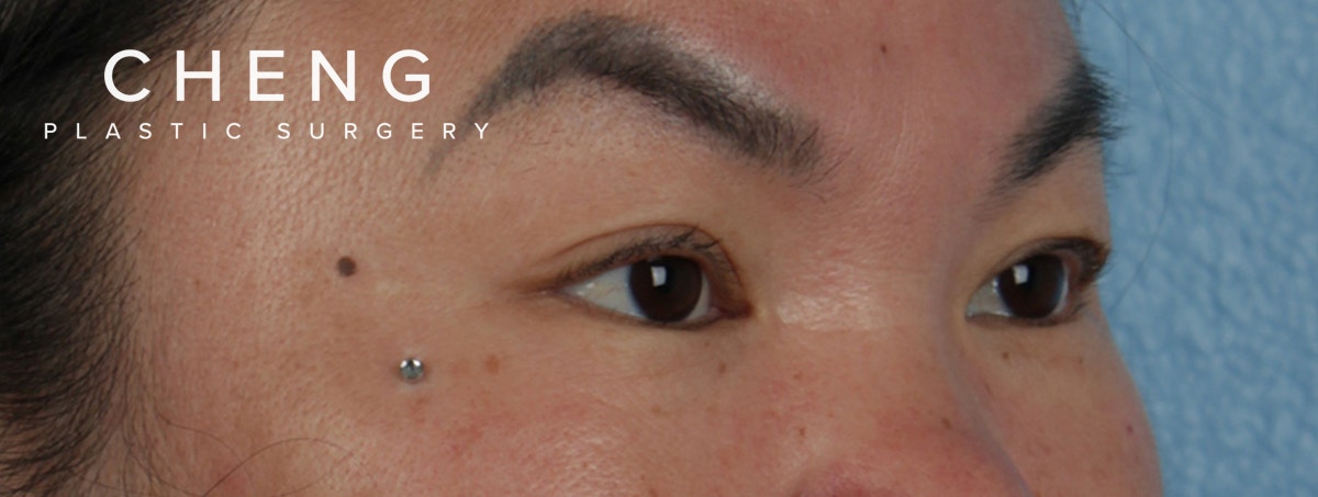 Hidden Patients Before & After Gallery - Patient 873403 - Image 3