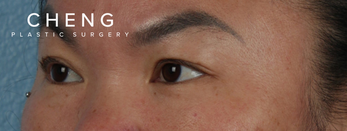 Hidden Patients Before & After Gallery - Patient 873403 - Image 5