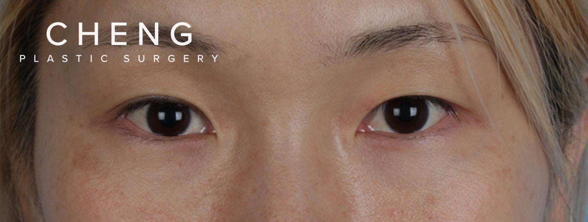 Blepharoplasty Before & After Gallery - Patient 309409 - Image 1