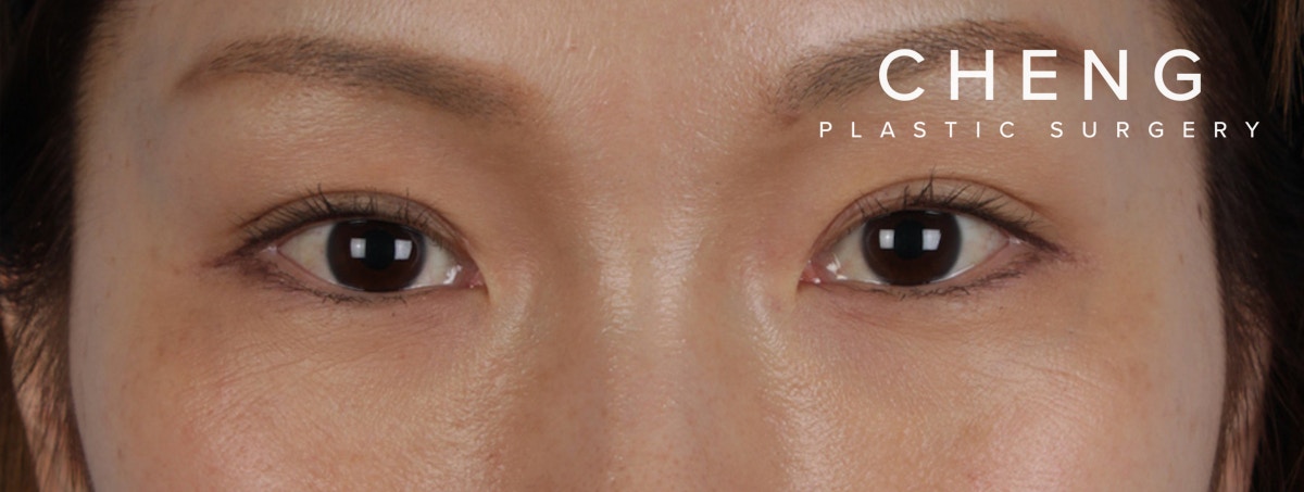 Blepharoplasty Before & After Gallery - Patient 309409 - Image 2