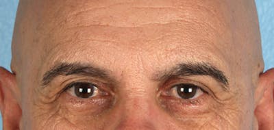 Hidden Patients Before & After Gallery - Patient 421996 - Image 1