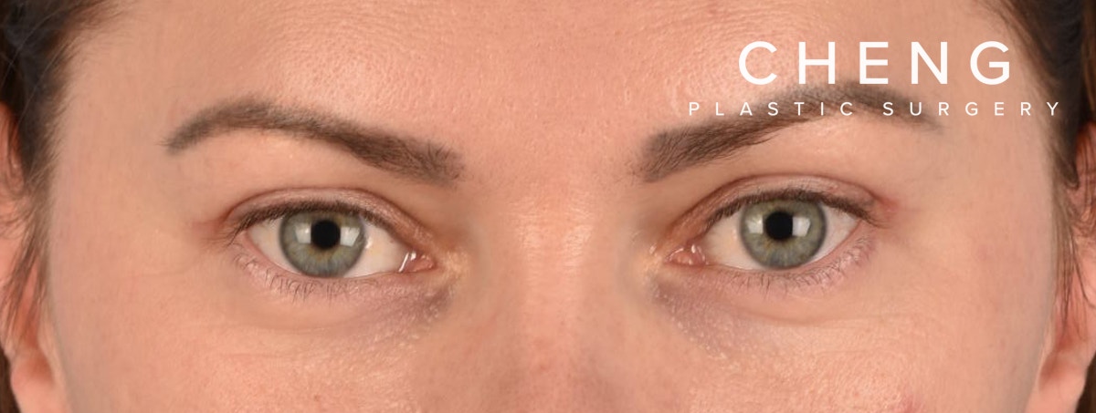 Blepharoplasty Before & After Gallery - Patient 386554 - Image 2