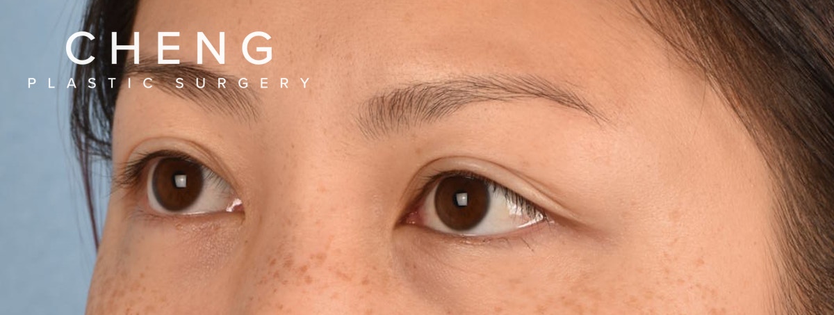 Hidden Patients Before & After Gallery - Patient 136681 - Image 3