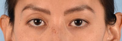 Hidden Patients Before & After Gallery - Patient 295978 - Image 1