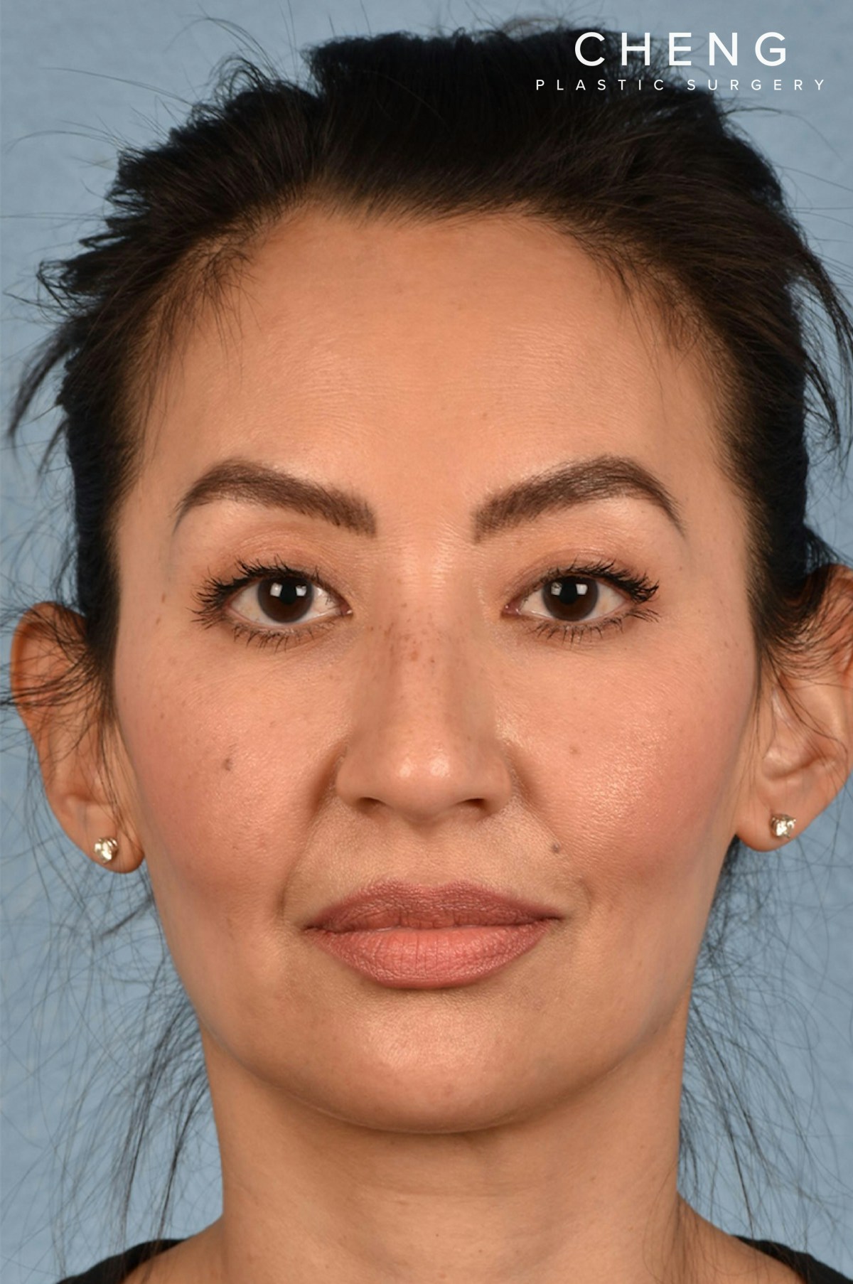 Hidden Patients Before & After Gallery - Patient 295978 - Image 4