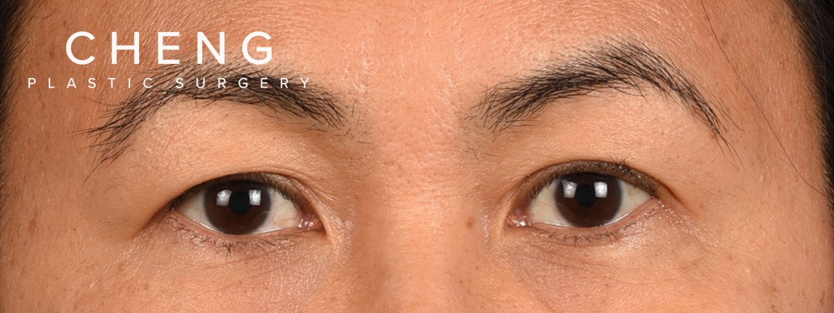 Blepharoplasty Before & After Gallery - Patient 374478 - Image 1