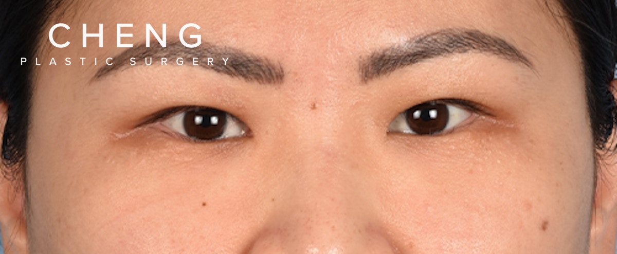 Hidden Patients Before & After Gallery - Patient 181350 - Image 1