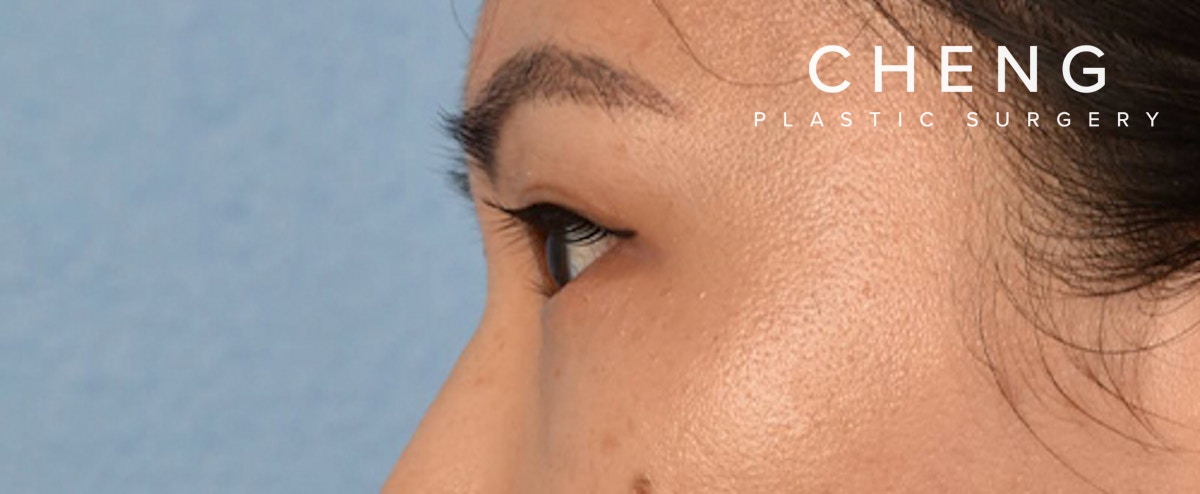 Hidden Patients Before & After Gallery - Patient 181350 - Image 6