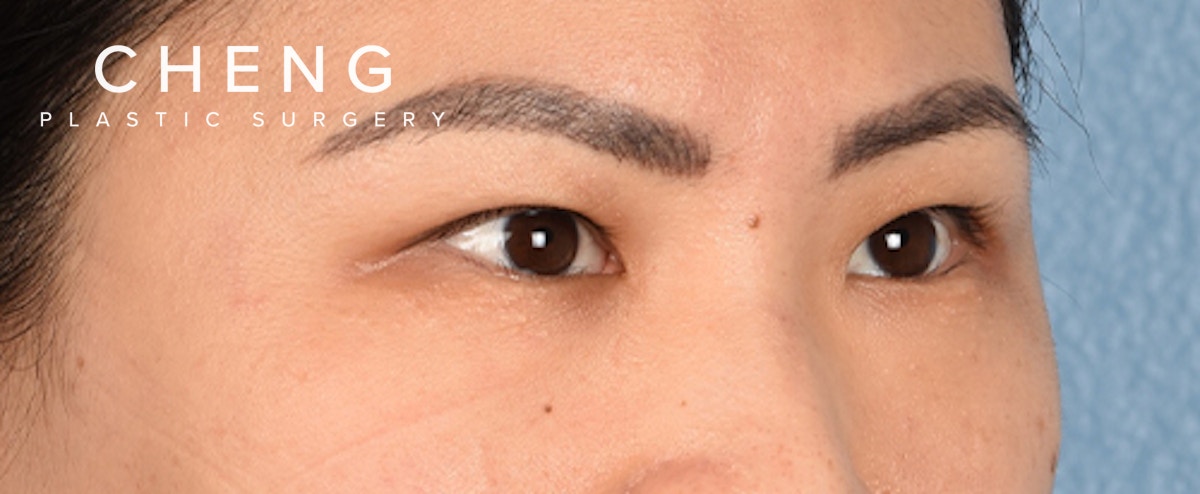 Hidden Patients Before & After Gallery - Patient 181350 - Image 7