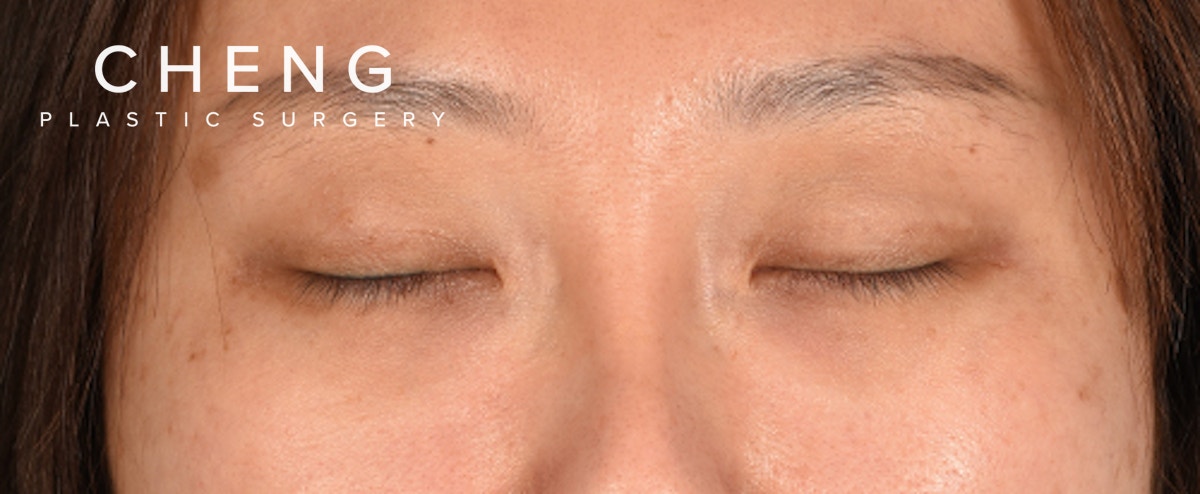 Hidden Patients Before & After Gallery - Patient 300838 - Image 3