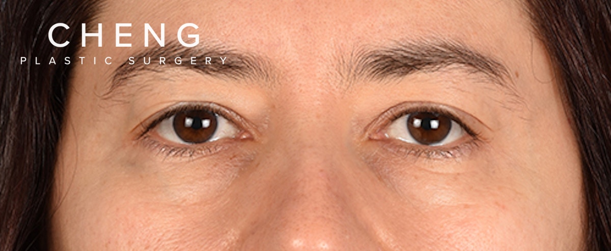Hidden Patients Before & After Gallery - Patient 239841 - Image 1