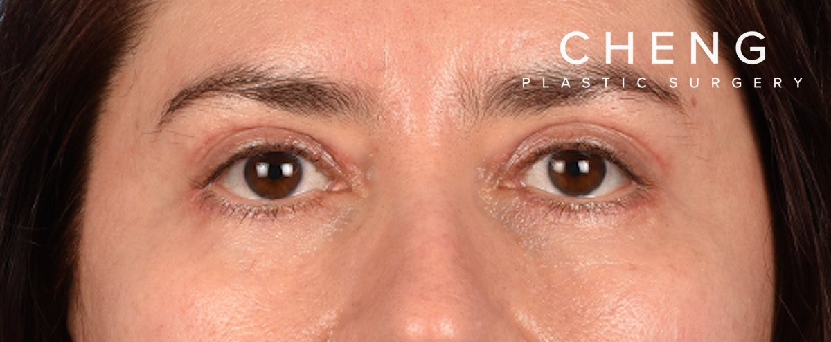 Hidden Patients Before & After Gallery - Patient 239841 - Image 2
