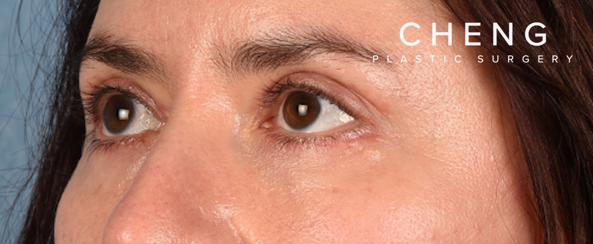 Hidden Patients Before & After Gallery - Patient 239841 - Image 4