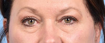 Hidden Patients Before & After Gallery - Patient 140219 - Image 1