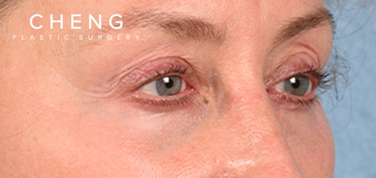 Hidden Patients Before & After Gallery - Patient 379996 - Image 3