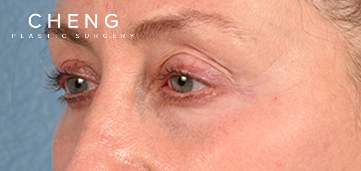 Hidden Patients Before & After Gallery - Patient 379996 - Image 5