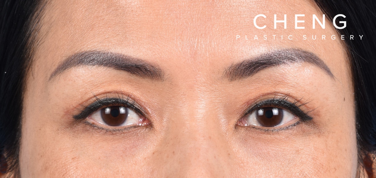 Hidden Patients Before & After Gallery - Patient 109685 - Image 2