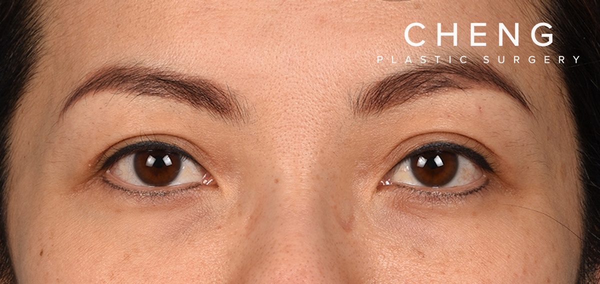 Blepharoplasty Before & After Gallery - Patient 651932 - Image 2