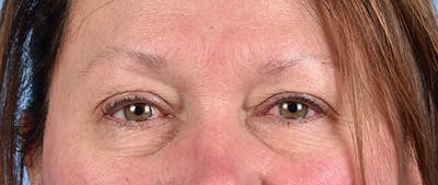 Hidden Patients Before & After Gallery - Patient 821760 - Image 1