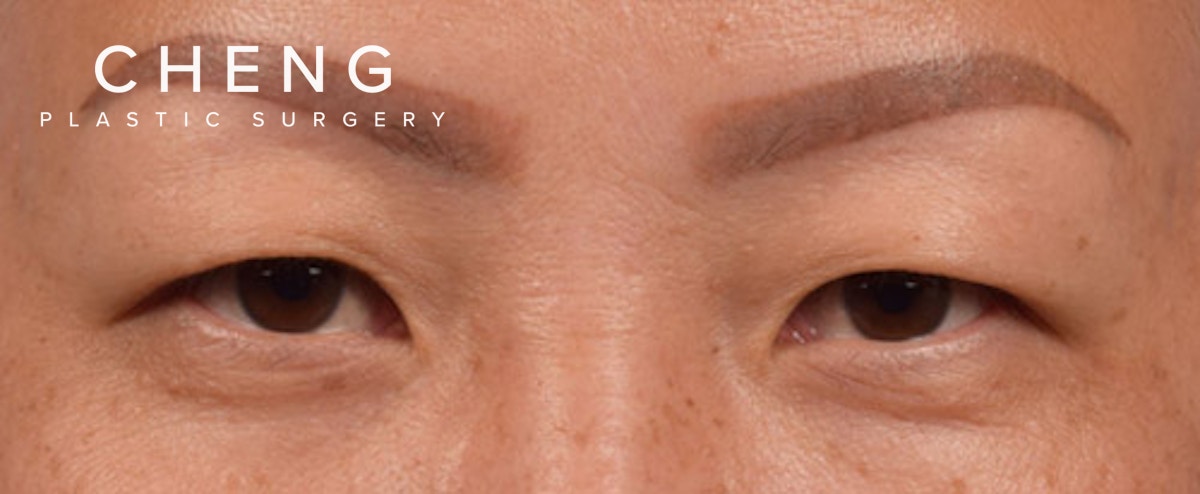 Hidden Patients Before & After Gallery - Patient 127674 - Image 1