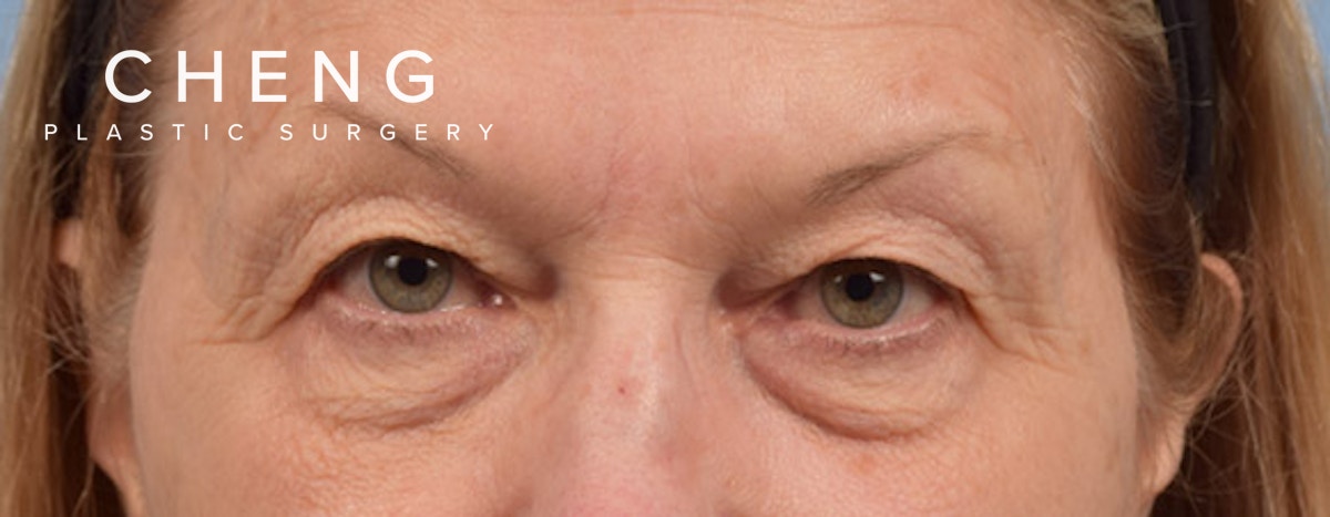 Hidden Patients Before & After Gallery - Patient 288598 - Image 1