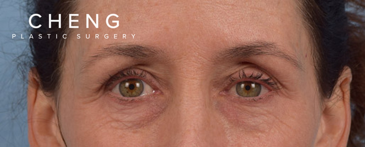Hidden Patients Before & After Gallery - Patient 440219 - Image 1