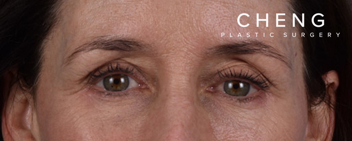 Hidden Patients Before & After Gallery - Patient 440219 - Image 2