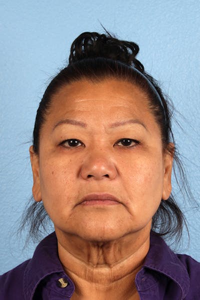 Hidden Patients Before & After Gallery - Patient 273819 - Image 1